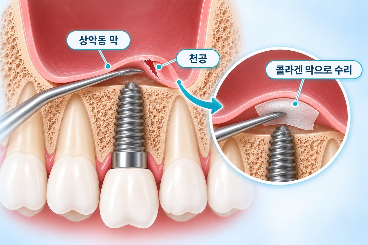 상악동거상술 중 상악동 막이 천공된 부위를 콜라겐 막으로 수리하는 과정을 보여주는 단면 도식