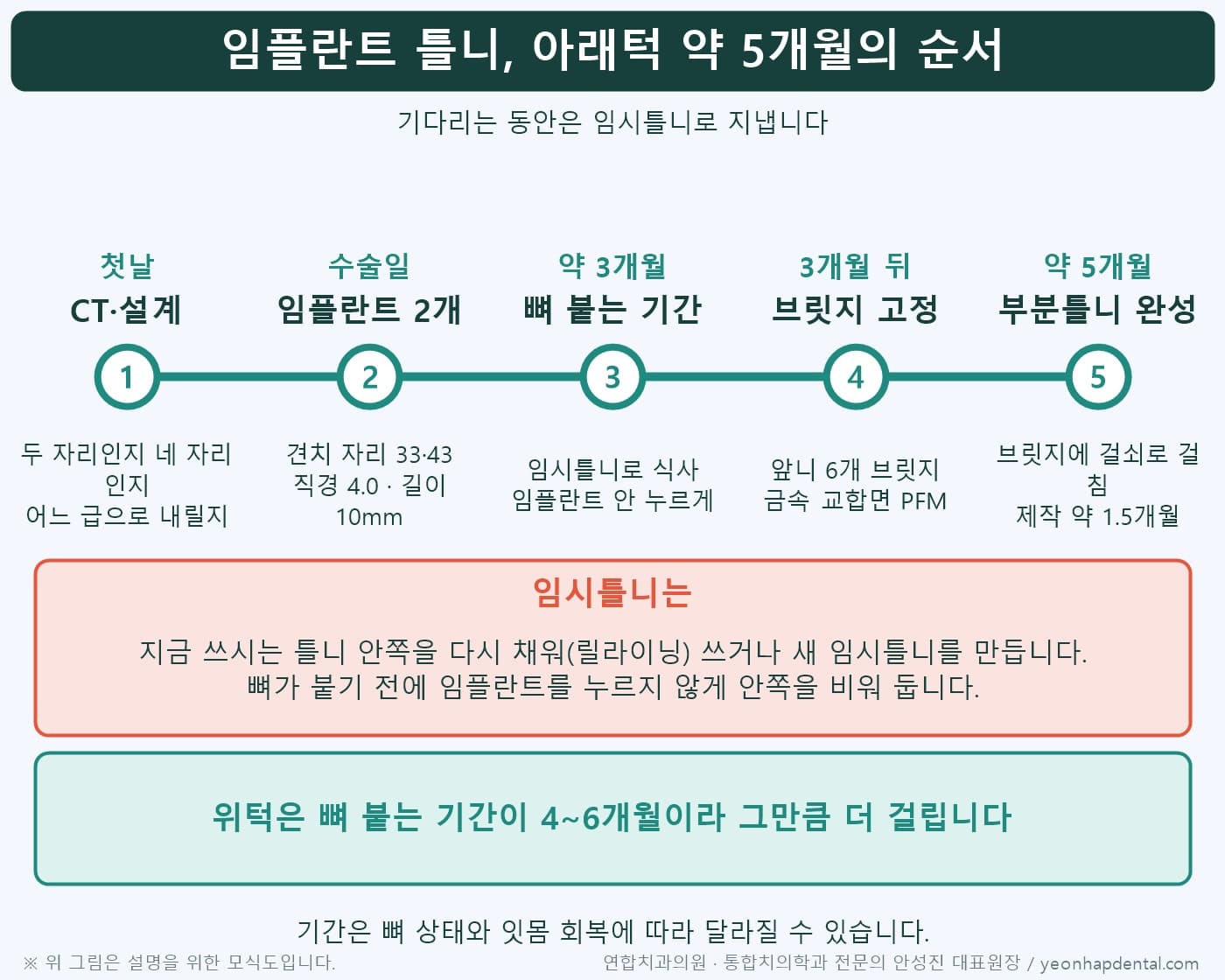임플란트 틀니 아래턱 치료 순서 5단계 타임라인, CT 설계부터 부분틀니 완성까지 약 5개월