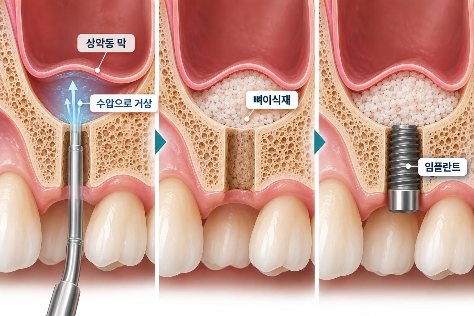 임플란트 식립 구멍을 통해 수압으로 상악동 막을 올리는 치조정 접근 상악동거상술 도식