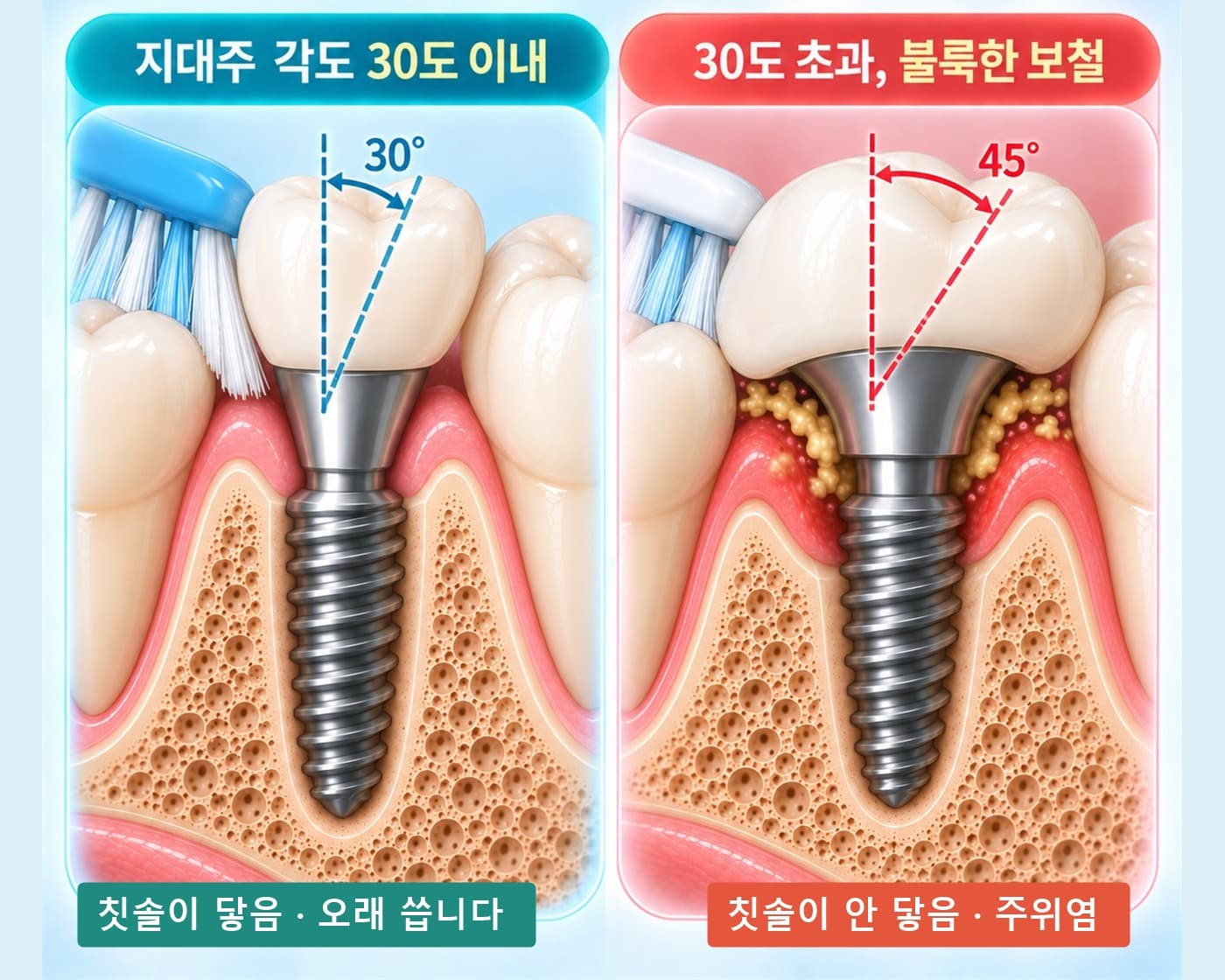 지대주 각도 30도 이내와 30도 초과 불룩한 크라운의 칫솔 접근 비교 모식도
