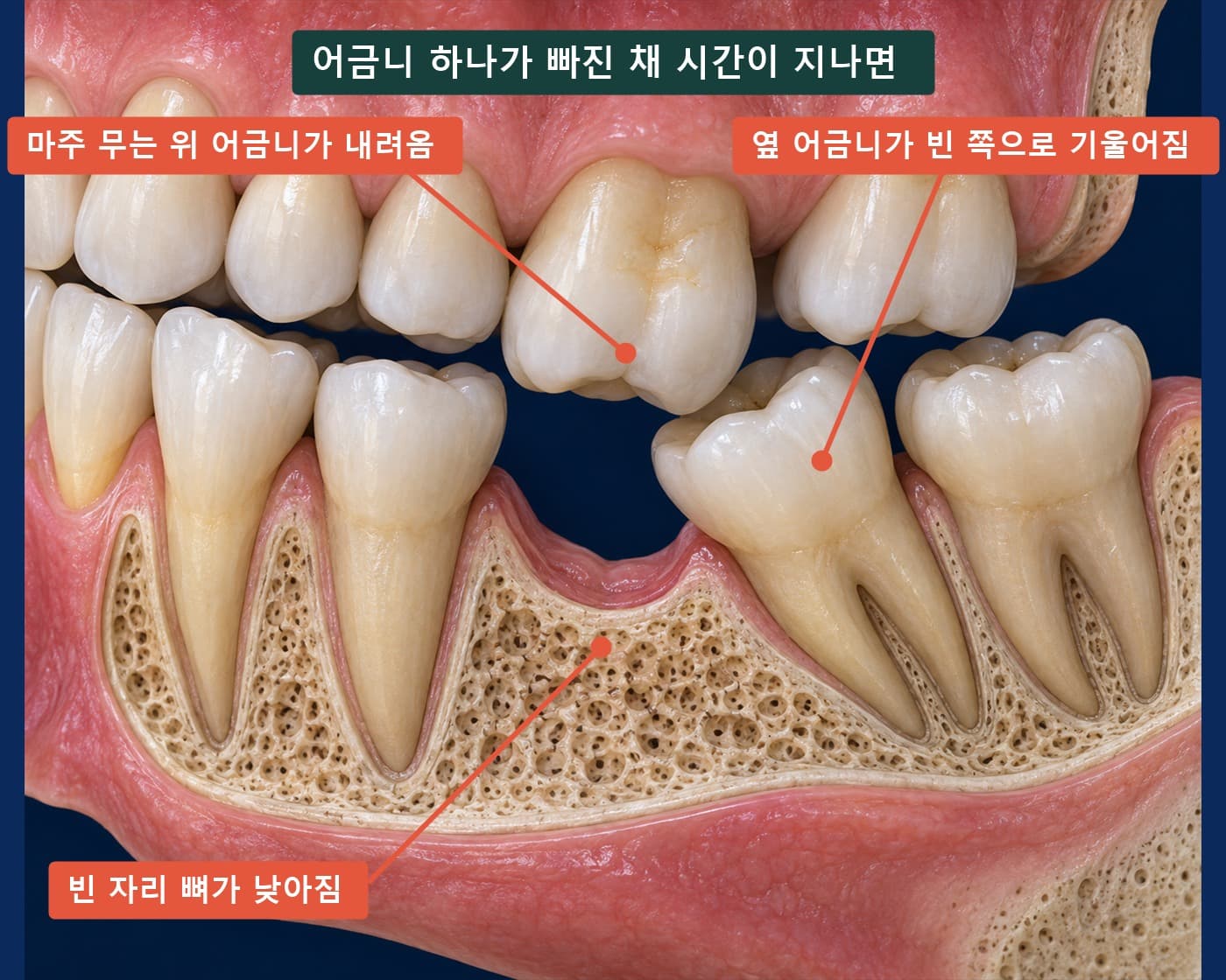 어금니 하나가 빠진 채 시간이 지난 단면: 위 어금니 정출, 옆 어금니 기울어짐, 빈 자리 뼈 하강