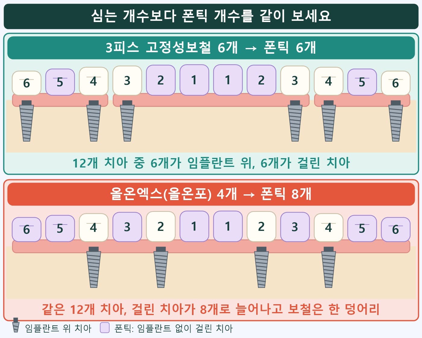 3피스 고정성보철 6개는 폰틱 6개, 올온엑스(올온포) 4개는 폰틱 8개를 색으로 표시한 비교 도식