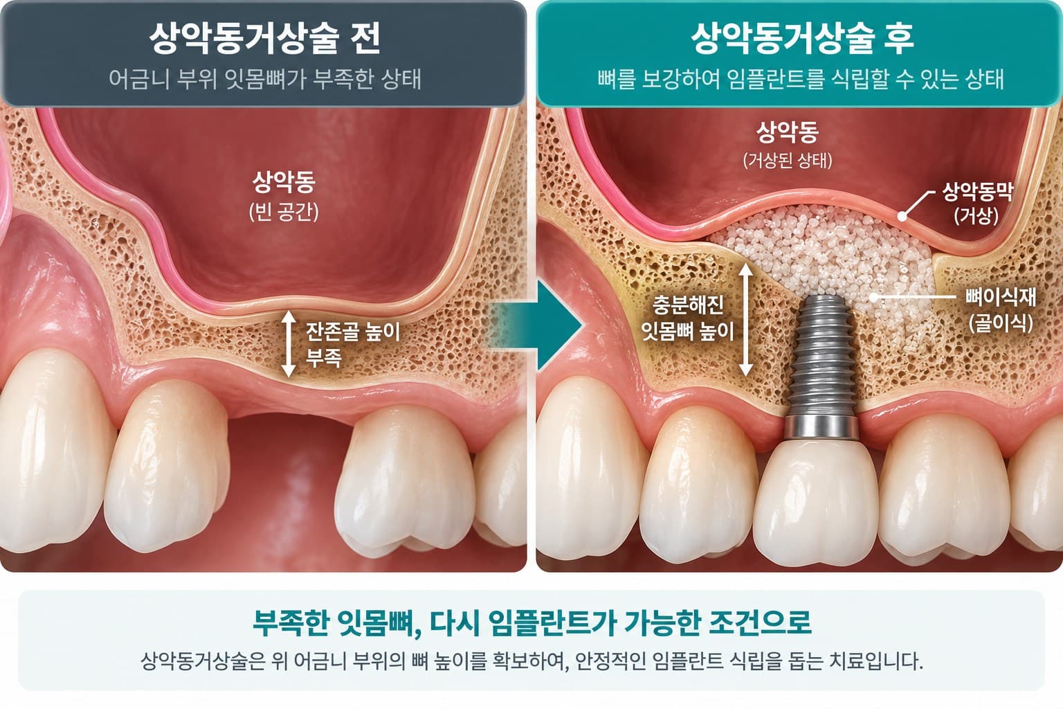 상악동거상술 전후 도식, 잔존골이 부족한 위 어금니 부위에 상악동막을 올리고 뼈이식재를 채워 임플란트를 식립한 모습