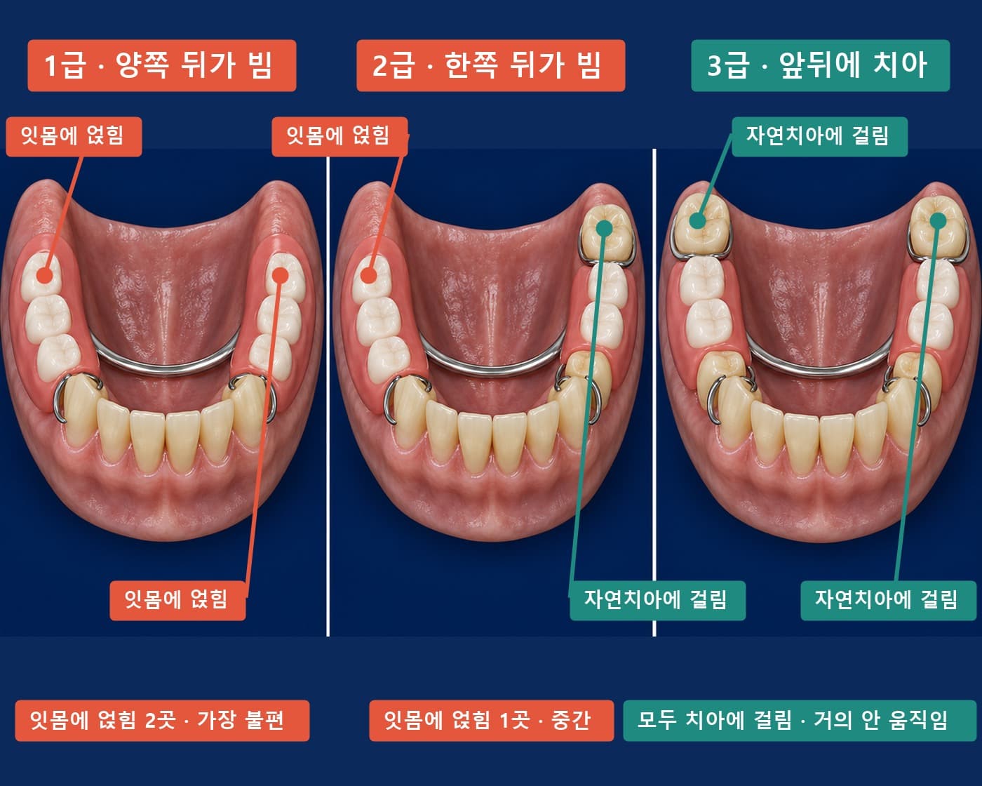 부분틀니 케네디 1급·2급·3급 실사풍 비교, 틀니 뒤끝이 잇몸에 놓인 곳과 치아에 걸린 곳