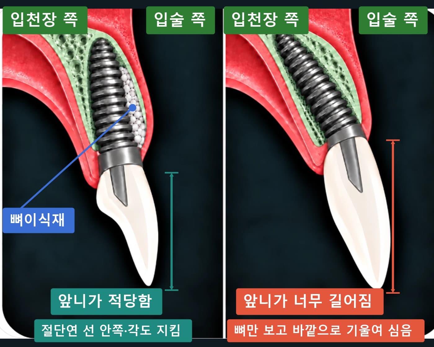 앞니 임플란트를 절단연 선 안쪽에 바르게 심은 경우와 뼈만 보고 안쪽으로 기울여 심어 크라운이 길어진 경우를 비교한 협설 단면 모식도