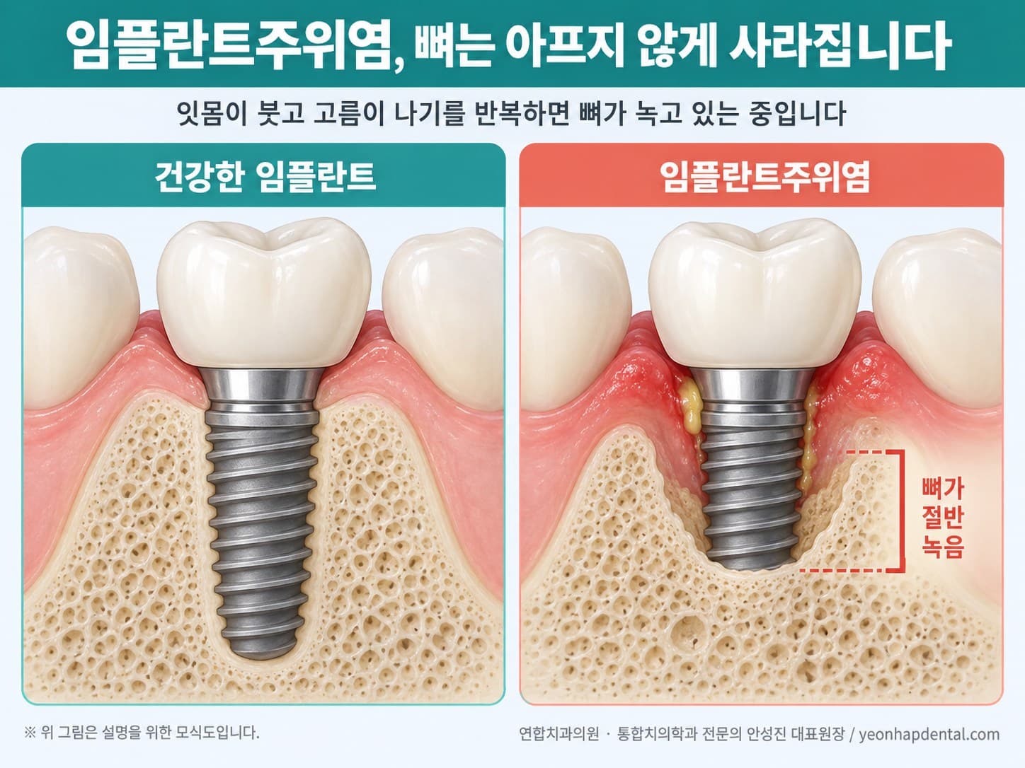 건강한 임플란트와 임플란트주위염으로 주위 뼈가 절반 녹은 임플란트를 비교한 단면 모식도
