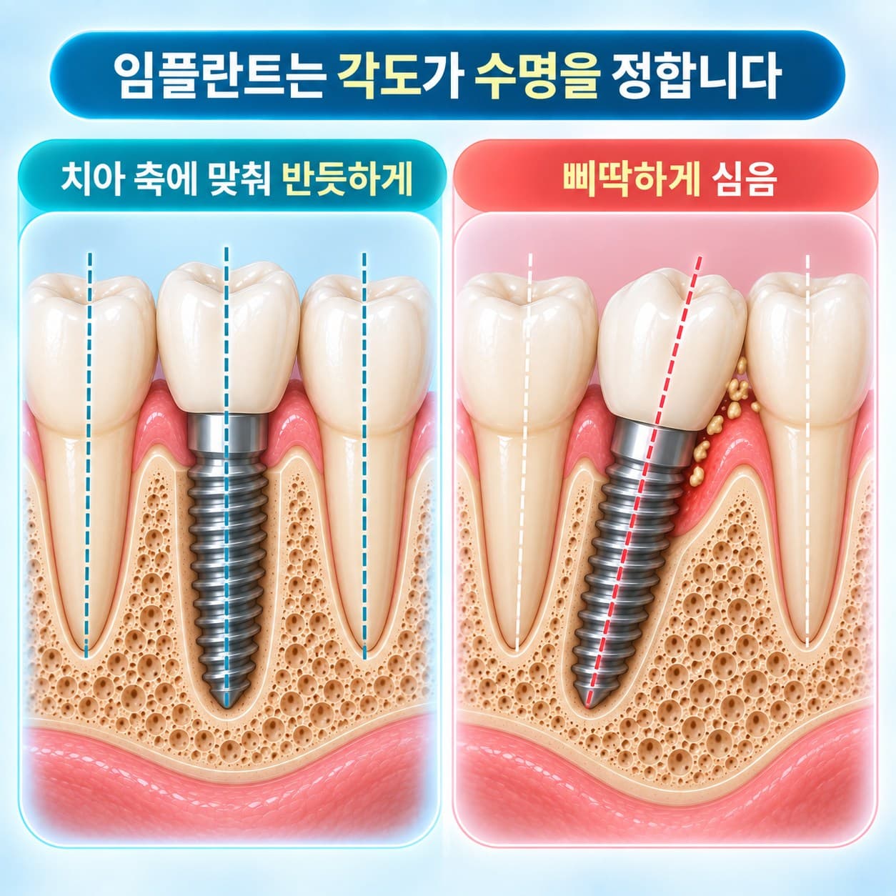 임플란트 식립 각도 비교 도식, 옆 치아 축에 맞춰 반듯하게 심은 경우와 삐딱하게 심은 경우
