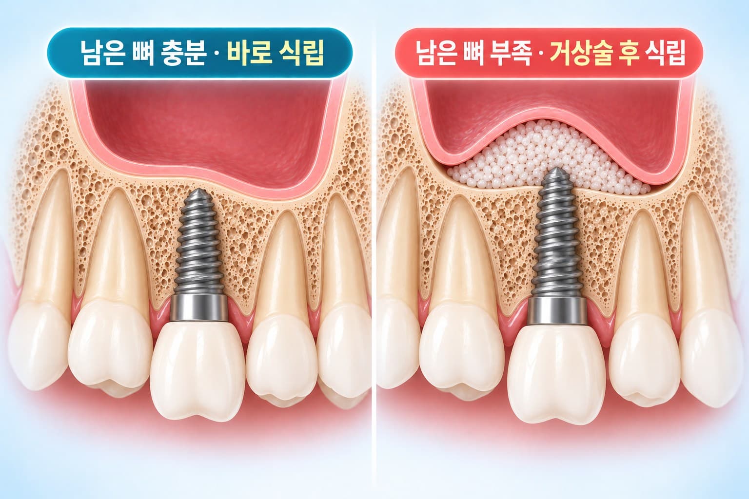 남은 뼈가 충분해 바로 식립한 경우와 부족해 상악동거상술 후 식립한 경우를 비교한 단면 도식