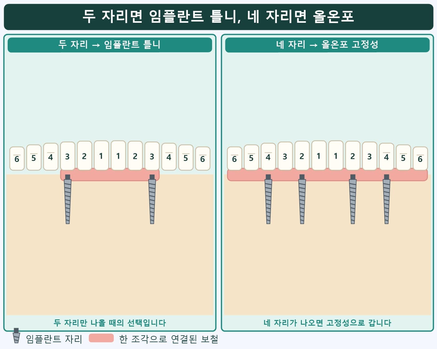 아래턱 임플란트 두 자리 임플란트 틀니와 네 자리 올온포 고정성 비교 도식