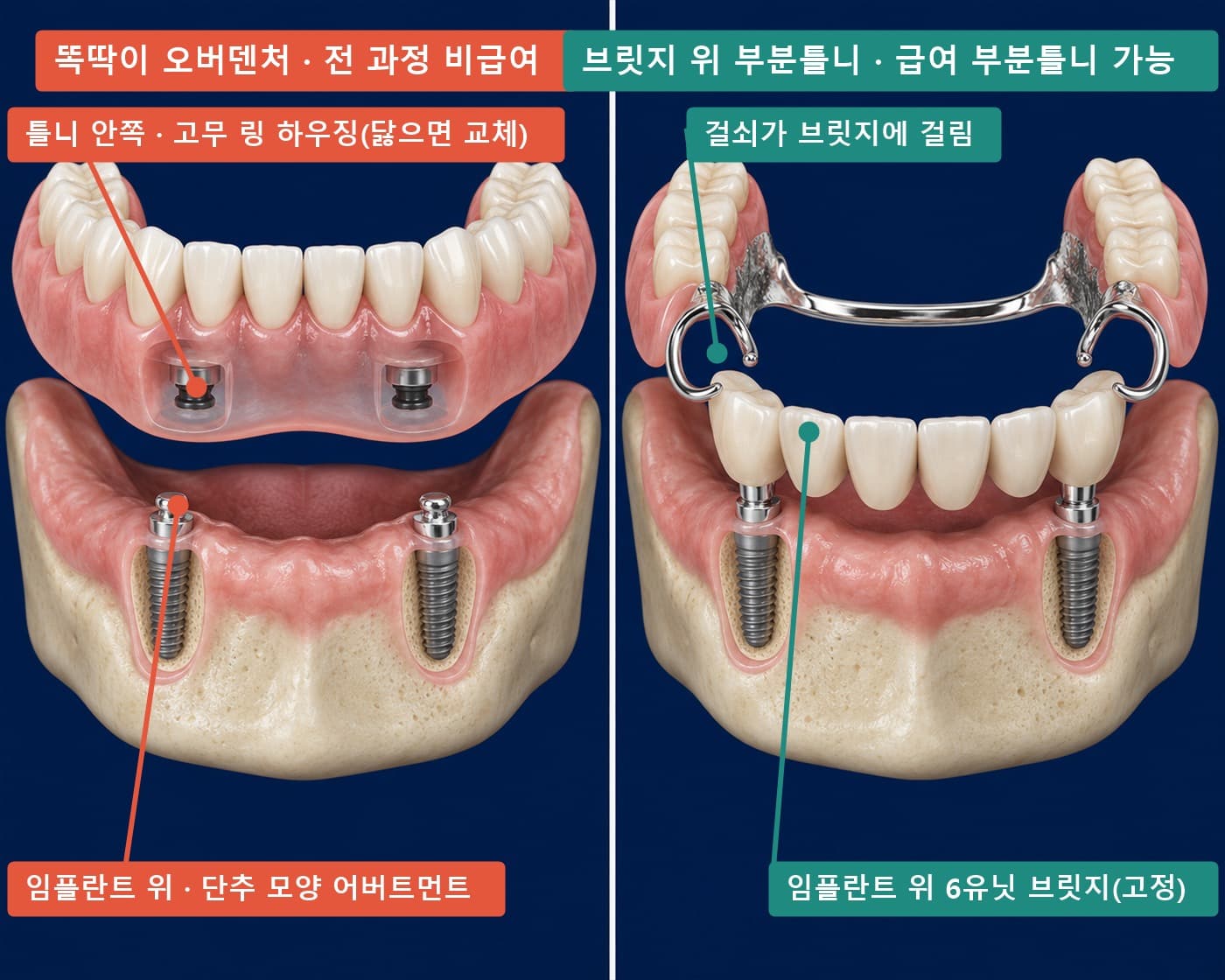 임플란트 오버덴처(단추형 어버트먼트와 틀니 안 고무 링 하우징)와 임플란트 브릿지 위 부분틀니 비교 실사풍 모식도
