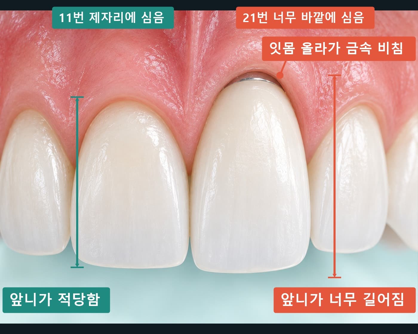 정상 길이의 11번 앞니와 잇몸이 내려가 길어 보이는 21번 임플란트 앞니를 비교한 정면 모식도