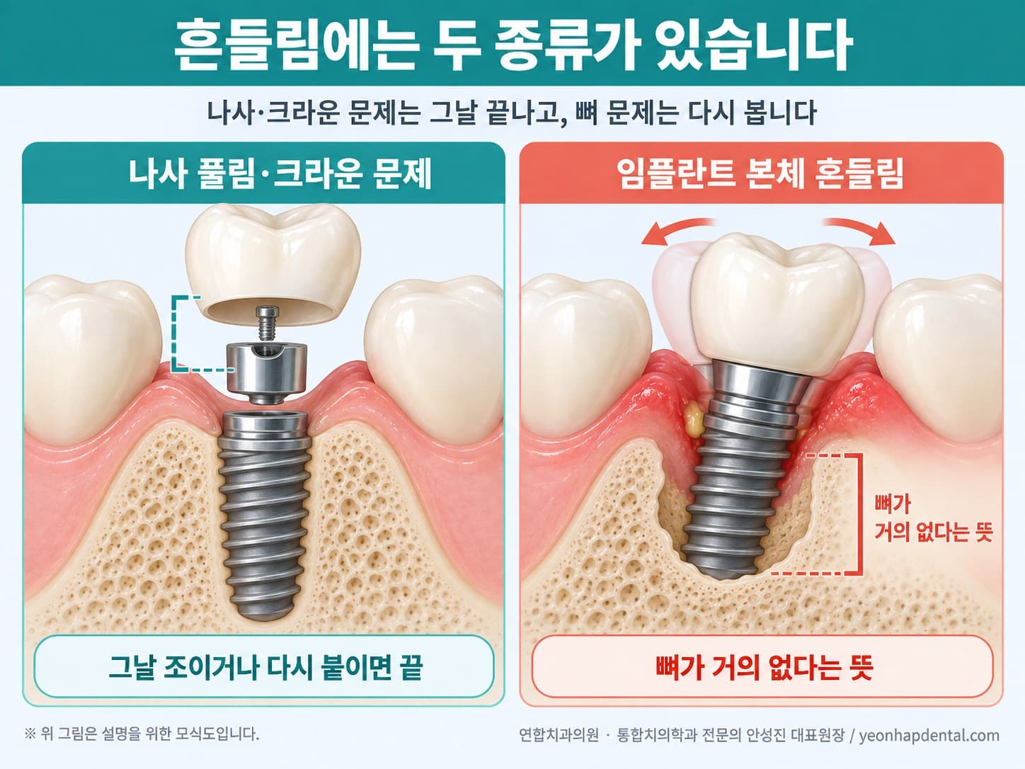 흔들림의 두 종류 모식도, 왼쪽은 나사·지대주·크라운 문제로 그날 해결, 오른쪽은 뼈가 녹아 임플란트 본체가 흔들리는 경우