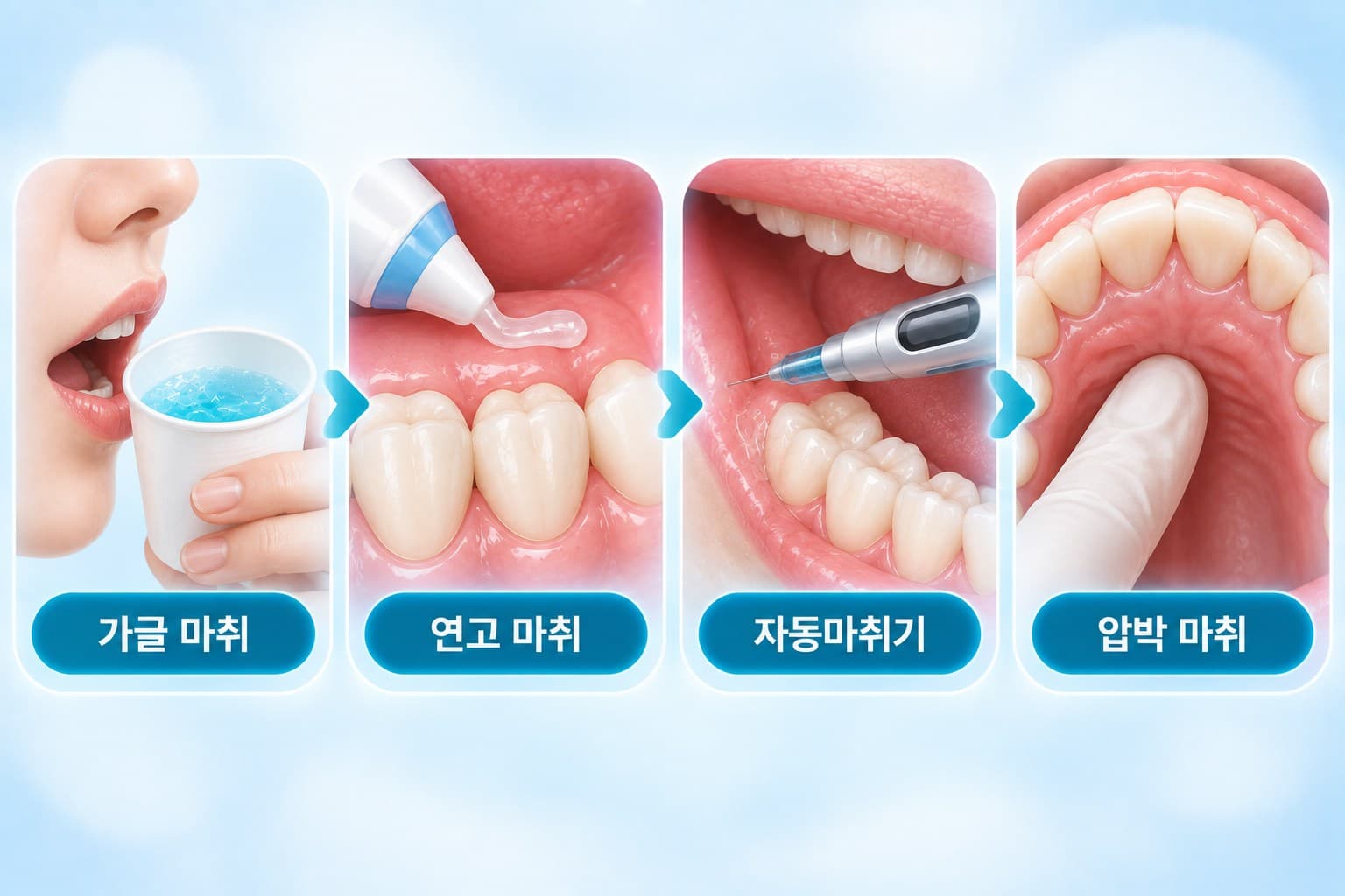 가글 마취, 연고 마취, 자동마취기, 구개측 압박 마취로 이어지는 임플란트 4단계 마취 도식