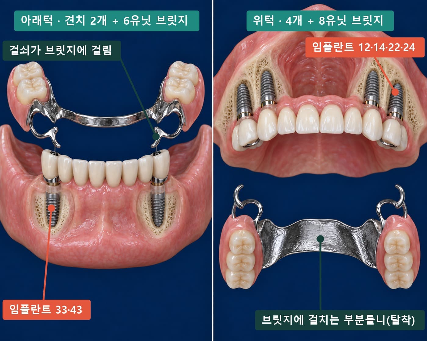 아래턱 33·43 임플란트 2개 위 6유닛 브릿지와 부분틀니, 위턱 임플란트 4개 위 8유닛 브릿지와 부분틀니 실사풍 모식도