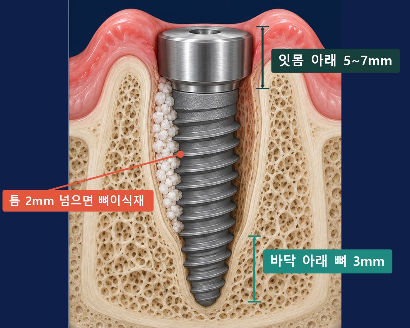 발치와에 심은 임플란트 단면에 바닥 아래 뼈 3mm, 잇몸 아래 5~7mm, 틈 2mm 뼈이식재를 표시한 모식도