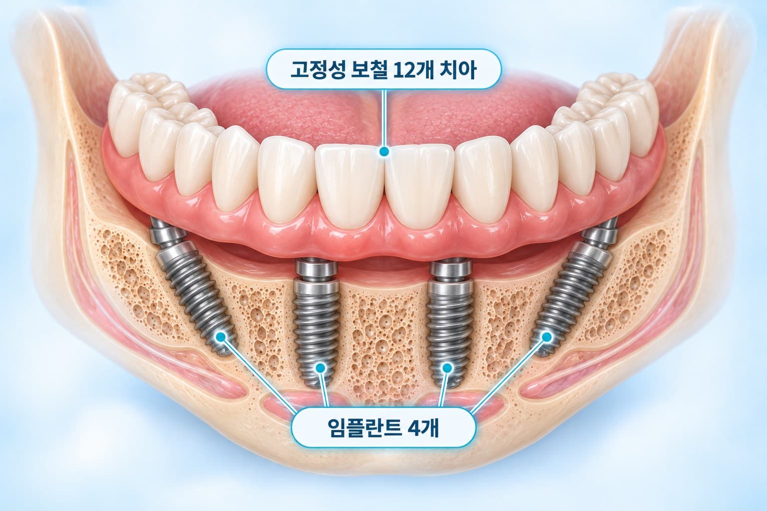 아래턱 앞쪽 4개 임플란트로 12개 치아를 한 덩어리로 고정한 올온포 모식도