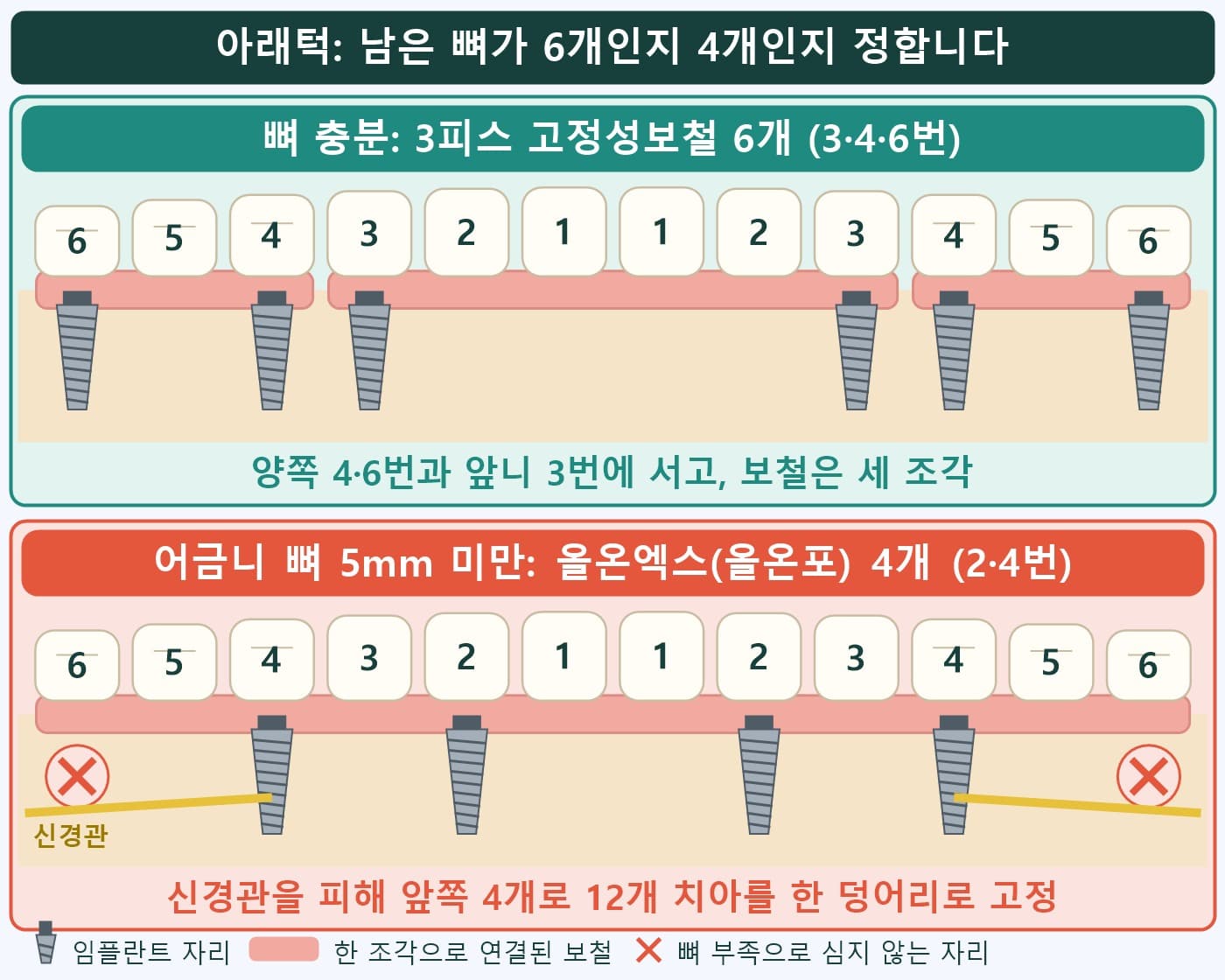 아래턱 3피스 고정성보철 6개 세 조각과 올온엑스 4개 한 덩어리 비교 도식