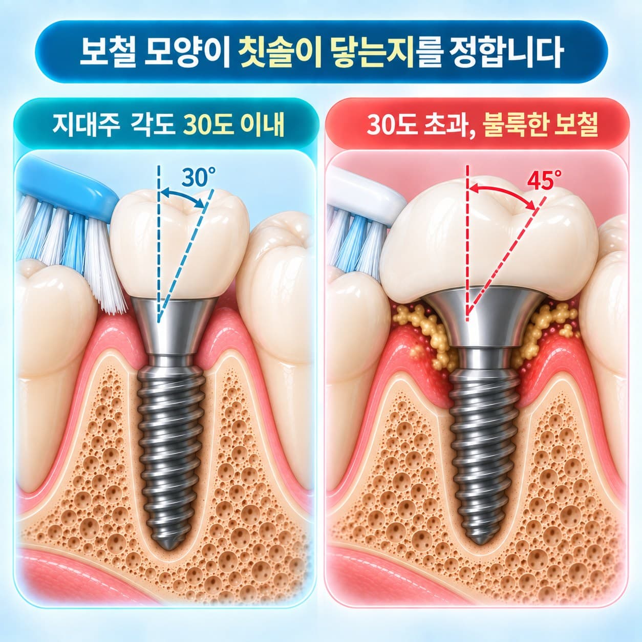 임플란트 지대주 각도 비교 도식, 30도 이내 날씬한 보철과 30도 초과 불룩한 보철