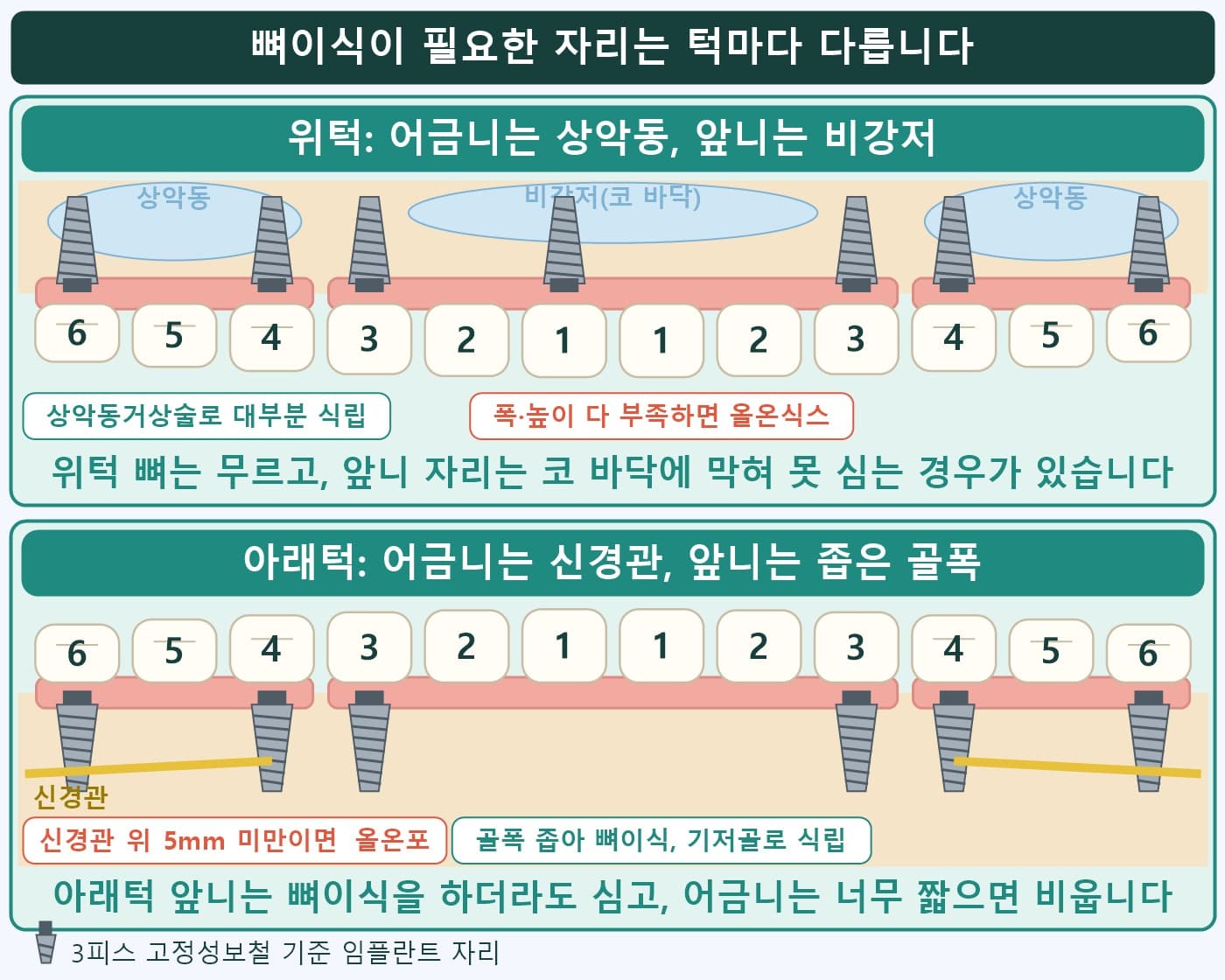 위턱 상악동·비강저와 아래턱 신경관·좁은 골폭을 표시한 뼈이식 자리 도식