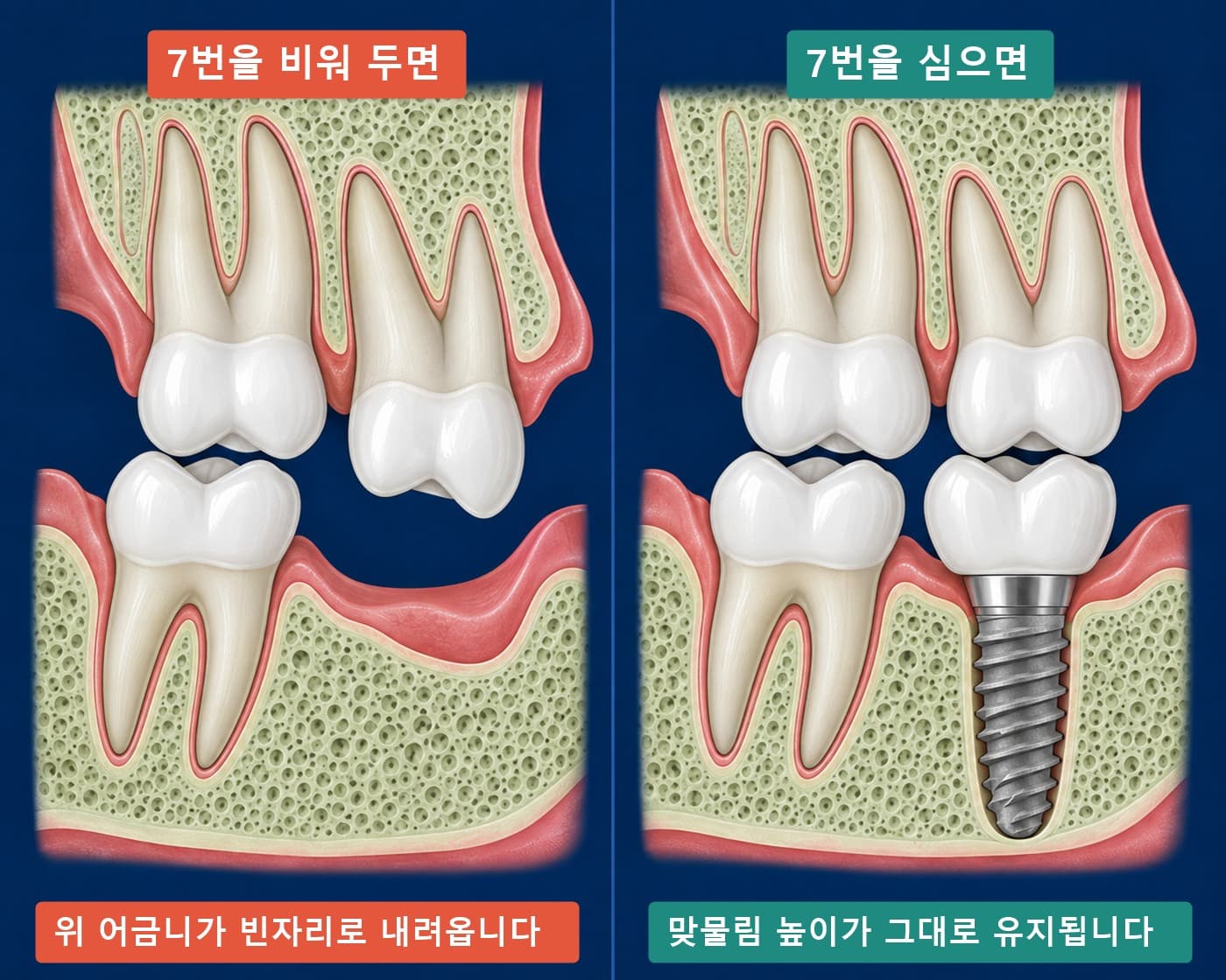 7번 어금니 하나를 비워 두면 맞물리는 치아가 내려온다는 것을 설명한 인포그래픽
