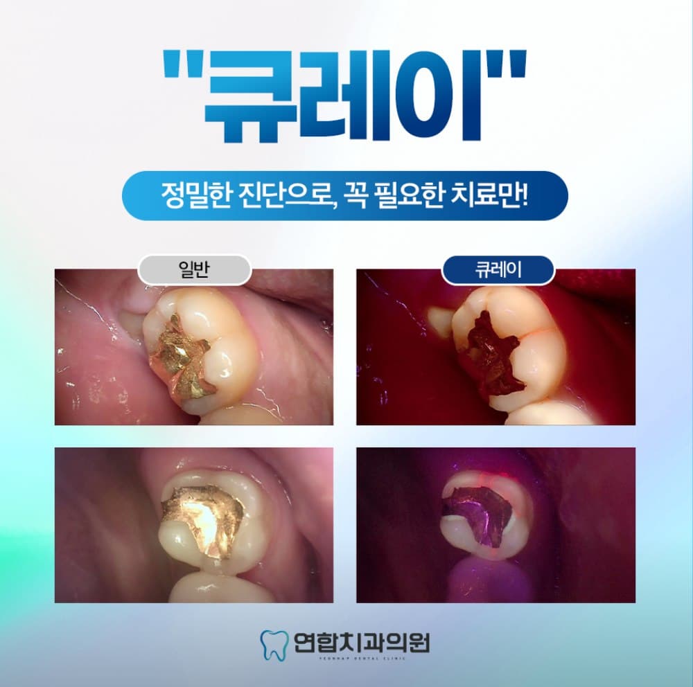 일반 구강 사진과 큐레이 형광 사진을 비교한 연합치과의원 정밀진단 안내