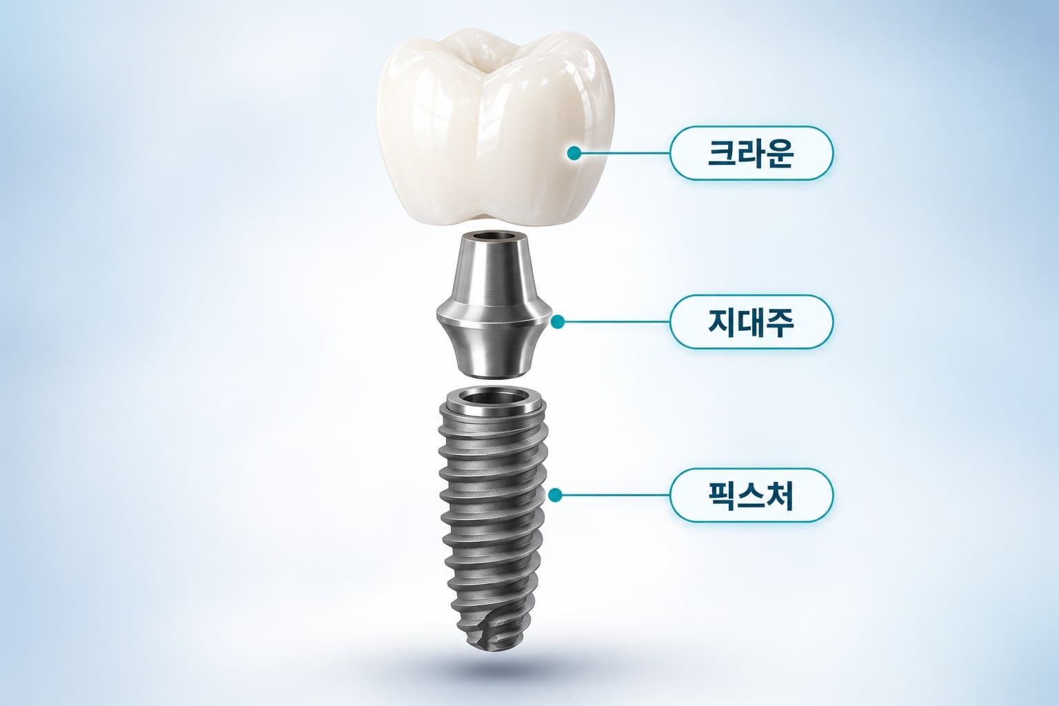 임플란트를 크라운, 지대주, 픽스처 세 부분으로 분리해 보여주는 도식