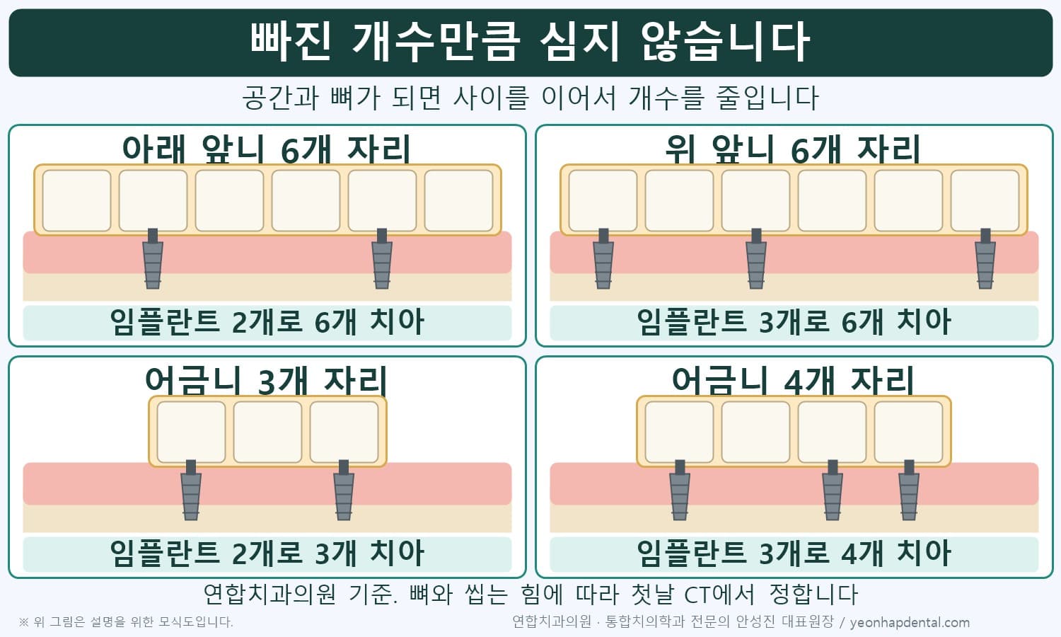 빠진 개수만큼 심지 않는 기준, 아래 앞니 6개 자리 2개·위 앞니 6개 자리 3개·어금니 3개 자리 2개·4개 자리 3개 모식도