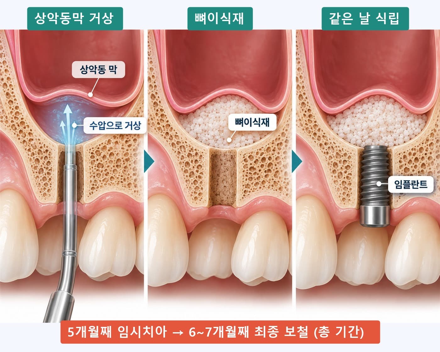 수압으로 상악동막을 올리고 뼈이식재를 넣은 뒤 같은 날 임플란트를 심는 세 단계 모식도, 5개월째 임시치아·6~7개월째 최종 보철