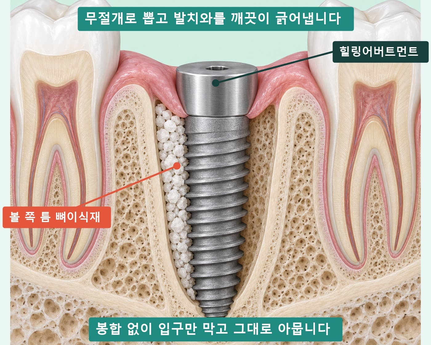 방금 뽑은 빈 발치와와 같은 자리에 심은 임플란트·힐링어버트먼트·볼 쪽 뼈이식재를 비교한 단면 모식도