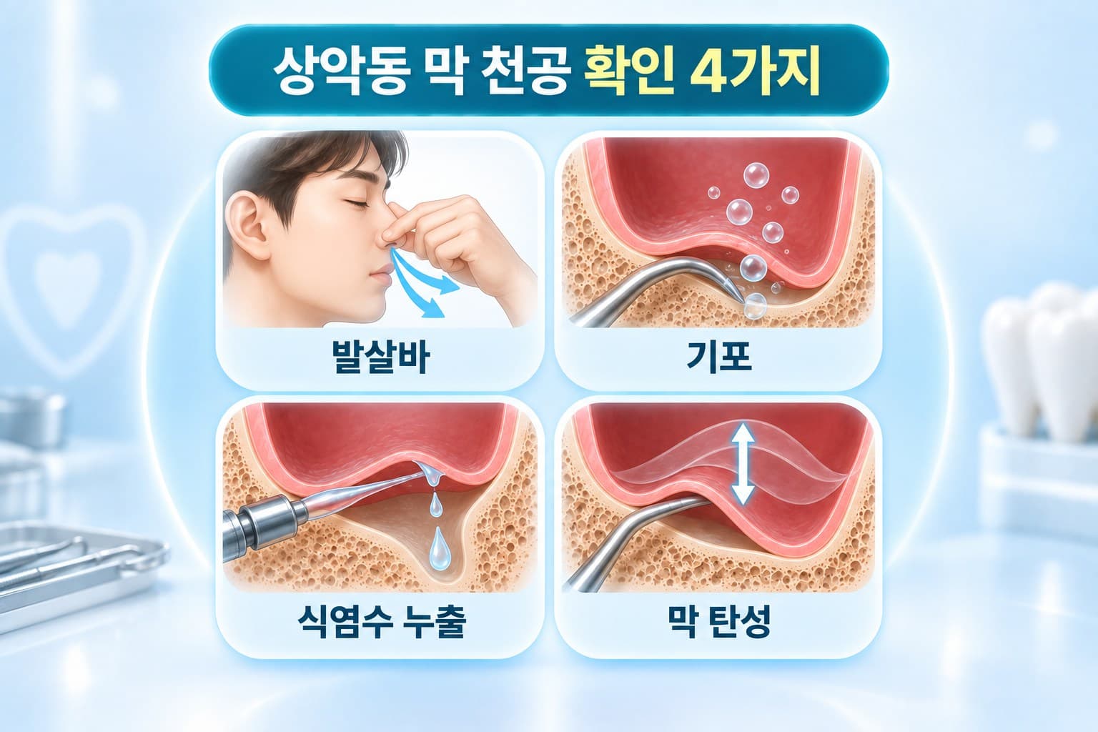 발살바, 기포, 식염수 누출, 막 탄성 네 가지로 상악동 막 천공을 확인하는 도식