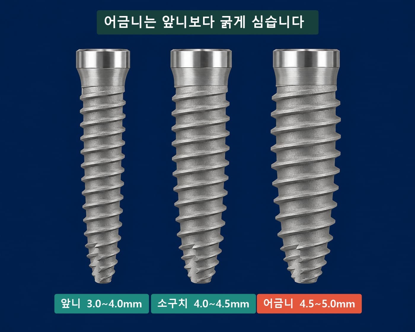 4번 4.0mm, 5번 4.5mm, 6·7번 4.5~5.0mm 어금니 임플란트 직경 기준 인포그래픽