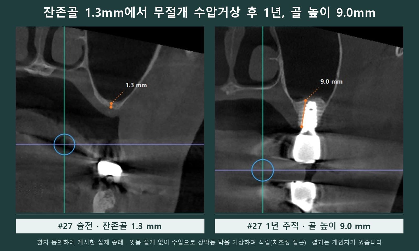 잔존골 1.3mm였던 위 어금니 부위를 무절개 수압거상으로 식립한 전후 CBCT, 1년 뒤 골 높이 9.0mm