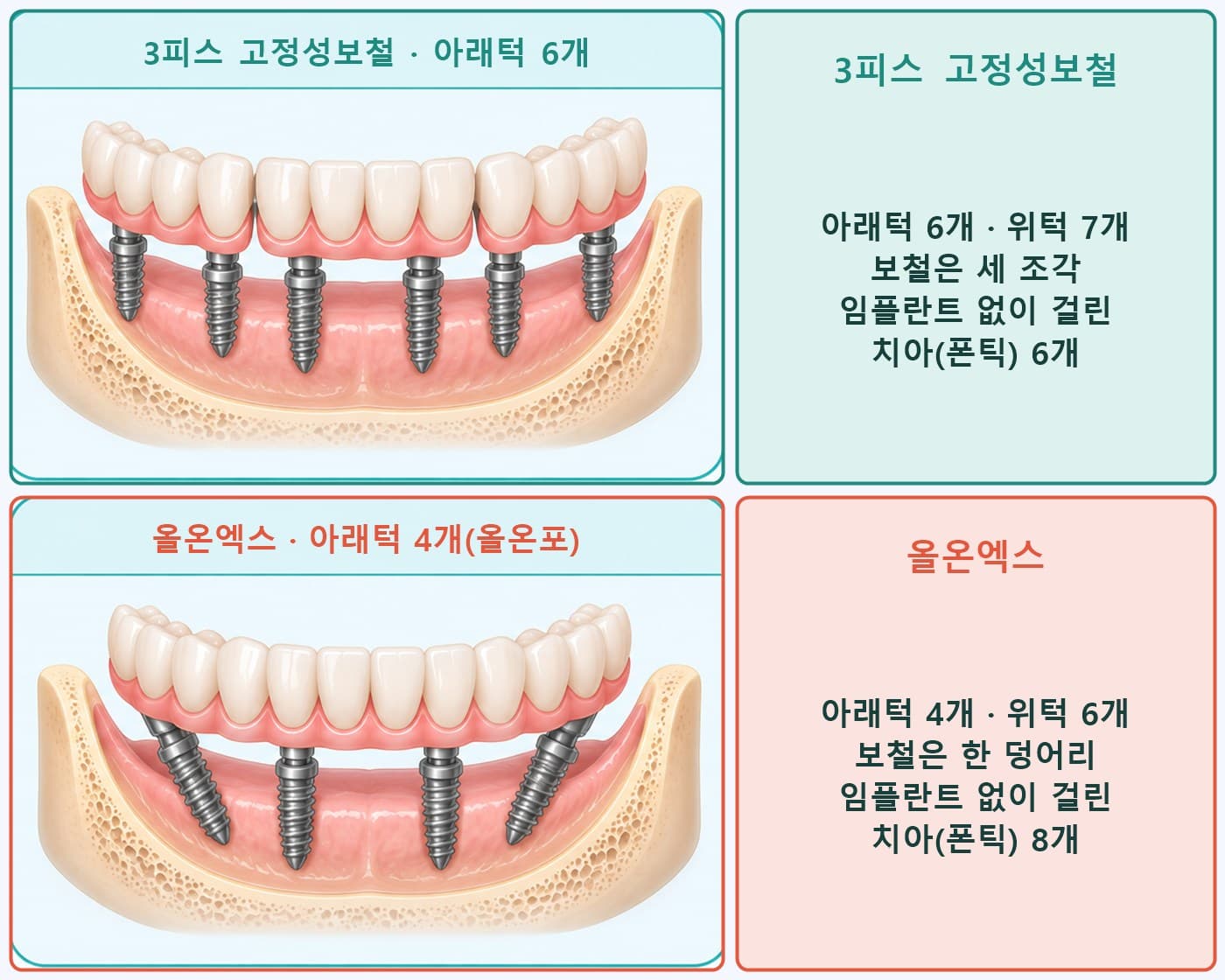 심는 개수 비교 그림, 3피스 고정성보철 아래턱 6개와 올온엑스 아래턱 4개