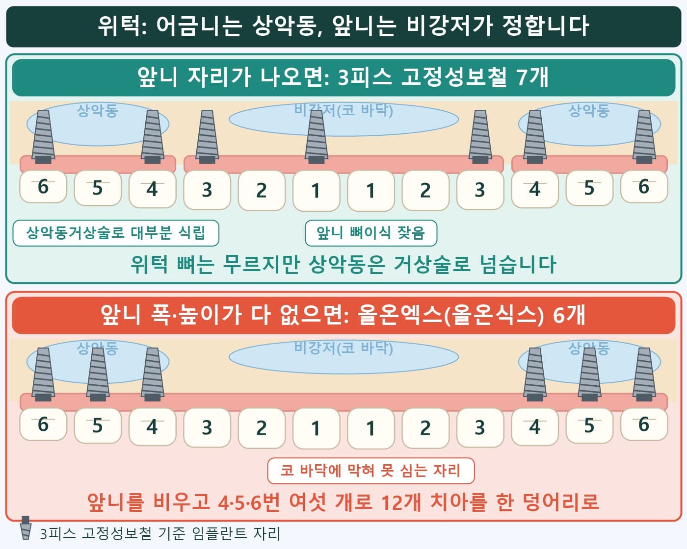 위턱 상악동과 비강저 위치를 표시한 도식, 앞니 자리가 나오면 3피스 고정성보철 7개, 없으면 올온엑스(올온식스) 6개