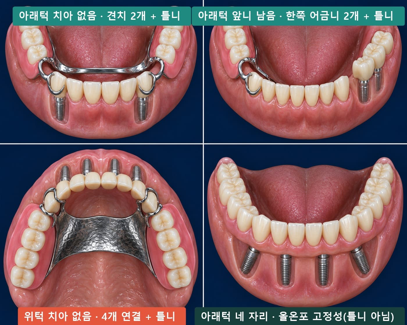 임플란트 틀니 네 가지 상황 실사풍 모식도: 아래턱 치아 없음 견치 2개, 아래턱 앞니 남음 한쪽 어금니 2개, 위턱 4개 연결, 아래턱 네 자리 올온포