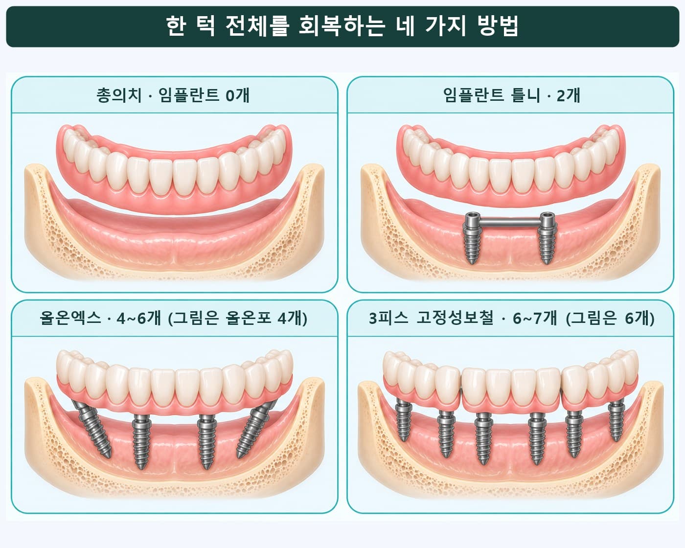 한 턱 전체를 회복하는 네 가지 방법 그림, 총의치·임플란트 틀니 2개·올온엑스(올온포 4개)·3피스 고정성보철 6개