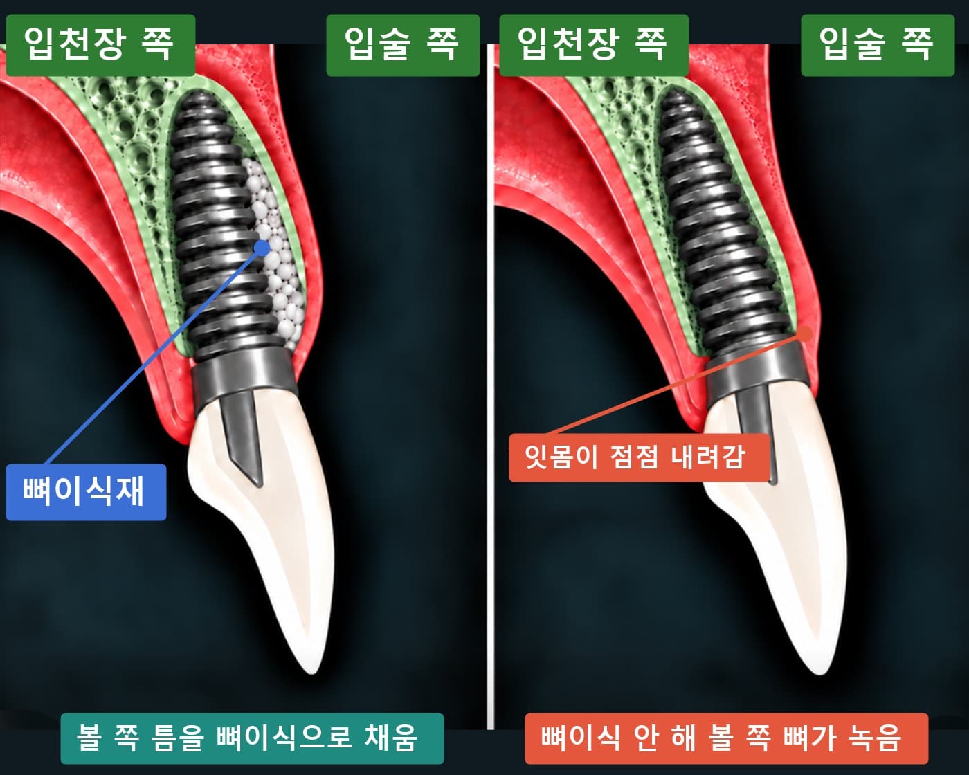볼 쪽 틈을 뼈이식으로 채운 앞니 임플란트와 뼈이식 없이 볼 쪽 뼈가 녹아 잇몸이 내려간 임플란트를 비교한 협설 단면 모식도