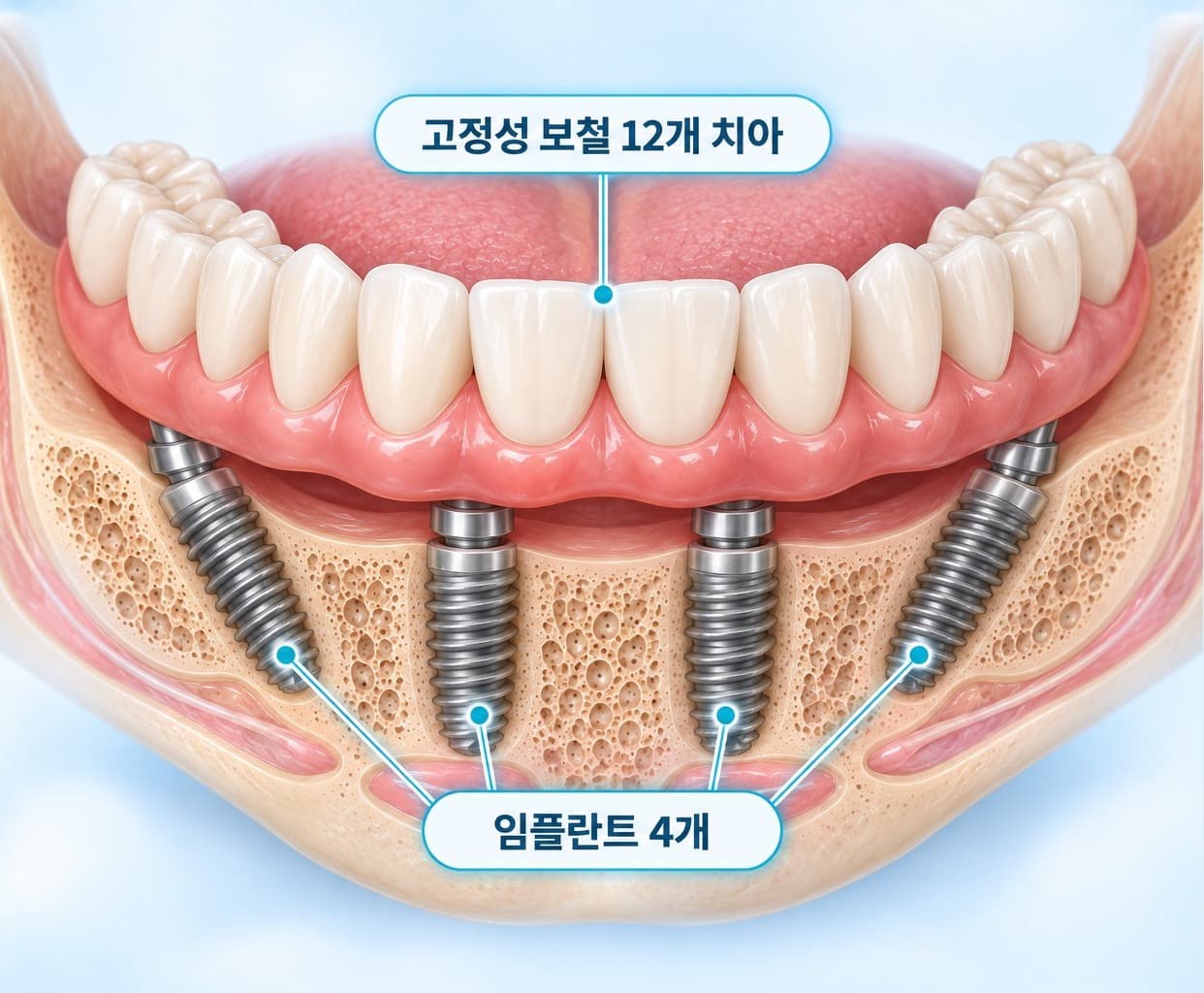 수원 권선구 연합치과의원 수술실에서 임플란트를 식립하는 통합치의학과 전문의