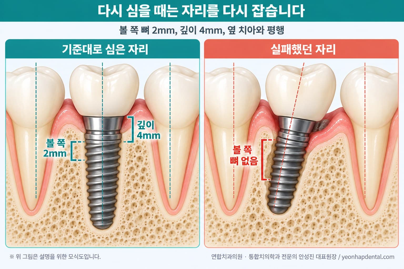 재식립 위치 기준 모식도, 볼 쪽 뼈 2mm·깊이 4mm·옆 치아와 평행한 위치와 그렇지 않은 위치 비교