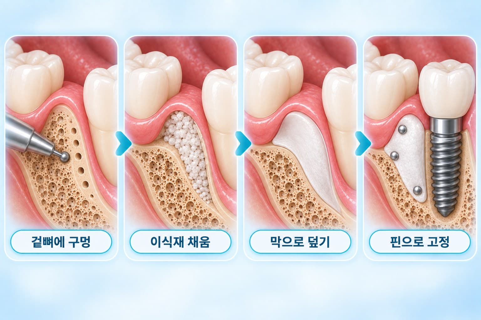 디코티케이션, 이종골 이식, 차폐막, 고정으로 이어지는 임플란트 뼈이식 4단계 도식