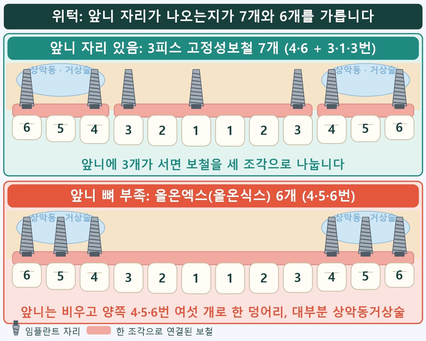 위턱 전악 비교 도식, 앞니 자리가 있으면 3피스 고정성보철 7개, 없으면 올온엑스(올온식스) 6개